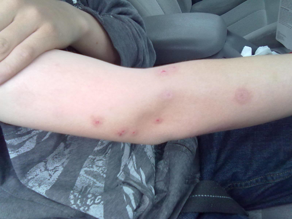 Close-up of bed bug bites on a person's arm, showing the need for pest control from HCR Bed Bug Specialists in Salt Lake City, UT.