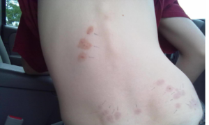 Multiple bed bug bites visible on a person's back, indicating a pest problem for HCR Bed Bug Specialists in Salt Lake City, UT.